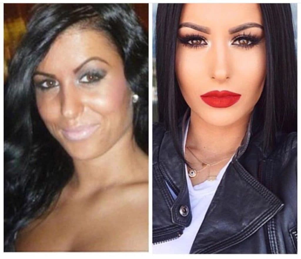 Amrezy Before And After Plastic Surgery
