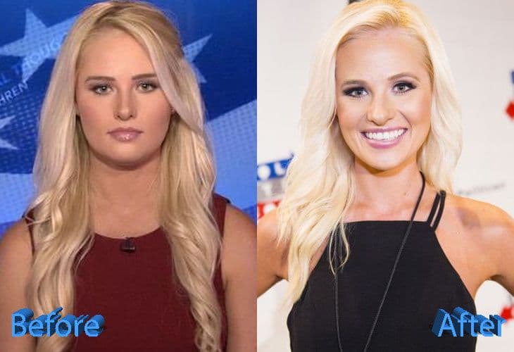 Tomi Lahren Before Plastic Surgery