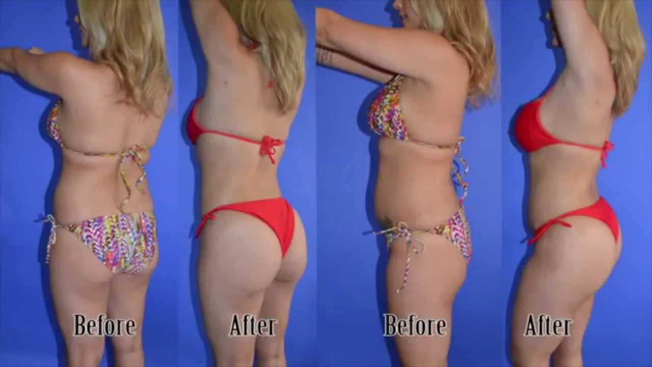Beautiful Plastic Surgery Before And After 1