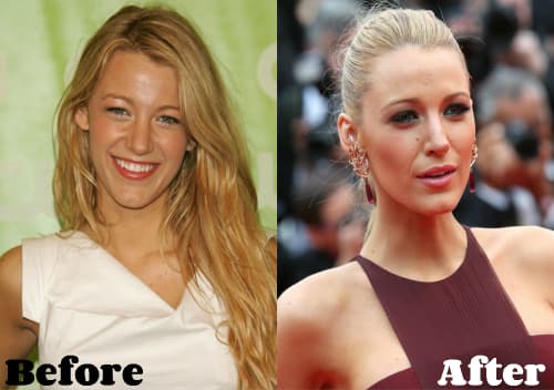 Blake Lively Before Plastic Surgery 1