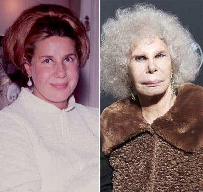 Duchess Of Alba Plastic Surgery Before And After 1