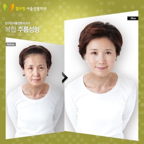 Korean Before And After Plastic Surgery Tumblr 1