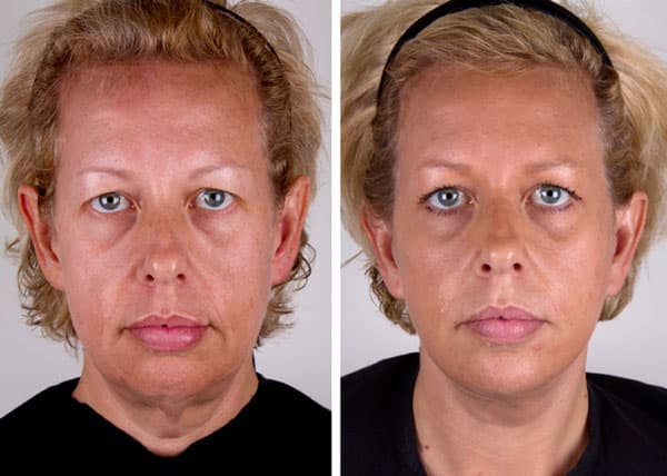 Plastic Surgery Jowls Before After Pictures 1