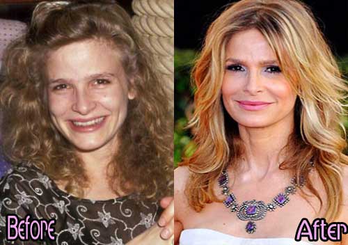 Before Plastic Surgery Celebrities 1