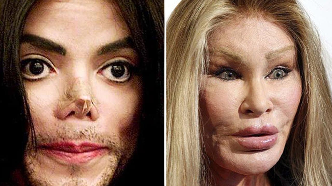 Celebrities Before And After Plastic Surgery Disasters 1