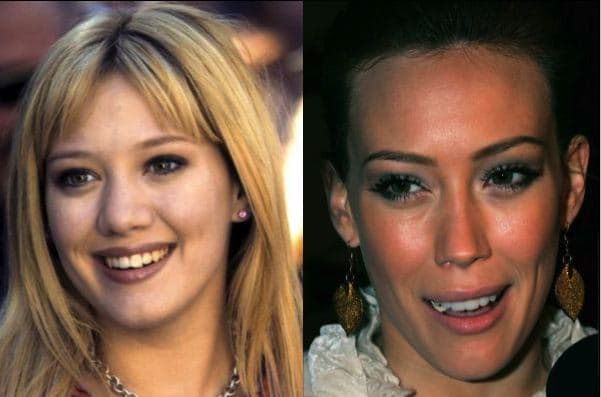 Celebrity Plastic Surgery Gone Wrong Before And After Pictures 1