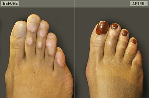 Foot Plastic Surgery Before And After 1