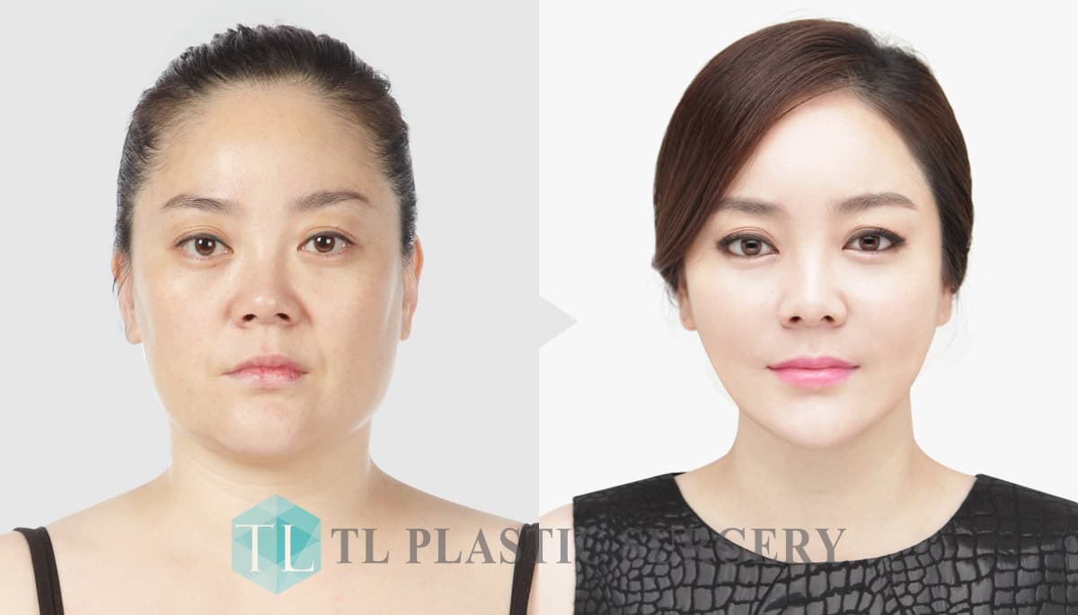 Forehead Plastic Surgery Before After 1