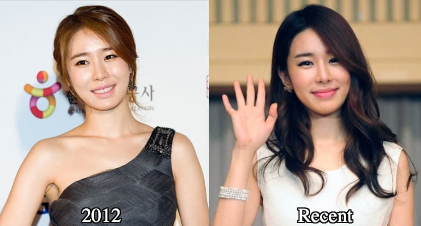 Korean Kpop Plastic Surgery Before And After 1