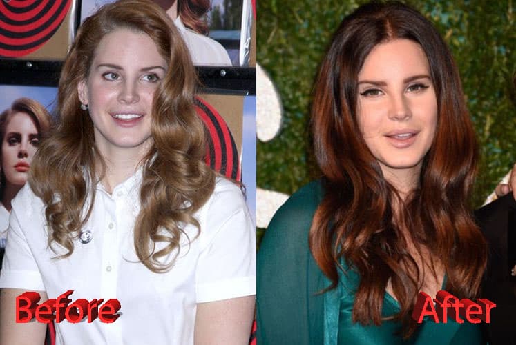 Lana Del Rey Before And After Plastic Surgery 1