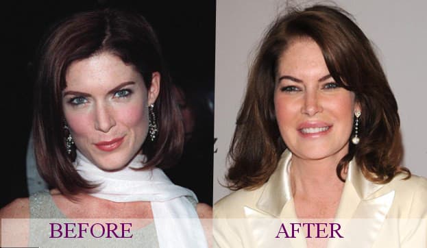Lara Flynn Boyle Before And After Plastic Surgery 1