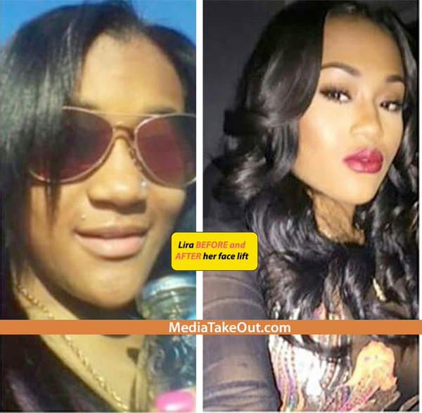 Miracle Watts Before And After Plastic Surgery 1