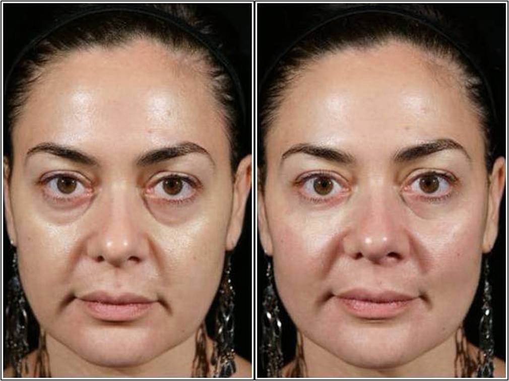 Plastic Surgery For Bags Under Eyes Before And After 1