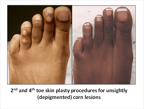 Plastic Surgery For Feet Before And After 1