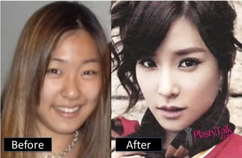 Snsd Plastic Surgery Before And After 1