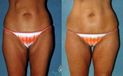 Thigh Plastic Surgery Before And After 1