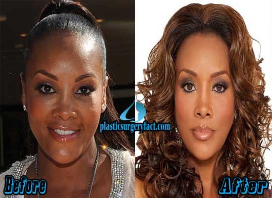 Vivica Fox Before And After Plastic Surgery 1