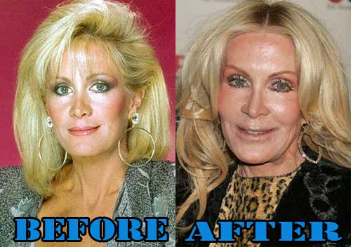 Actress Plastic Surgery Before And After 1