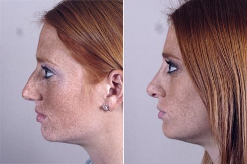 Before And After Face Plastic Surgery 1