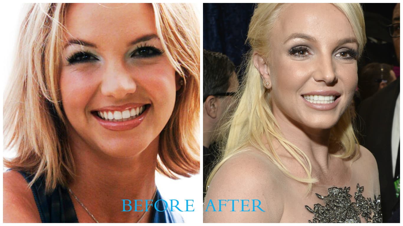 Britney Spears Plastic Surgery Before And After Pictures 1
