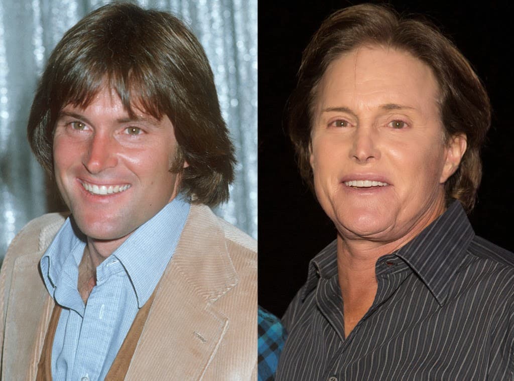 Bruce Jenner Before And After Plastic Surgery Pics 1