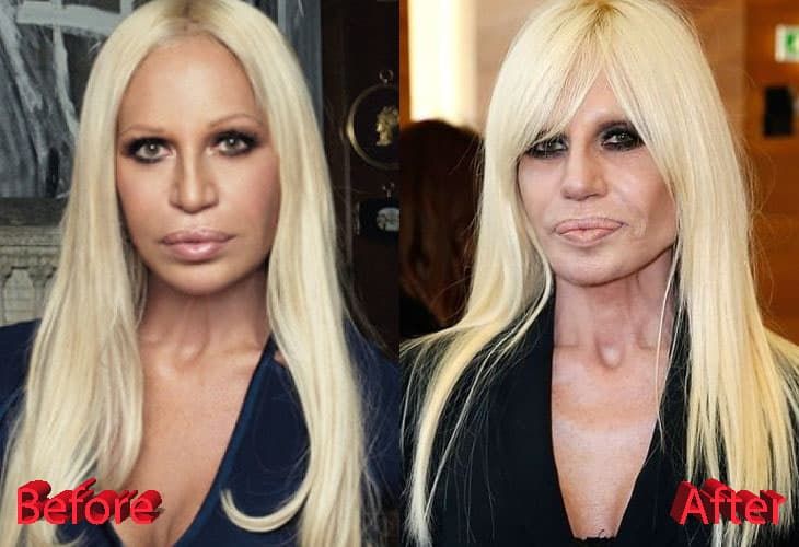 Donatella Versace Plastic Surgery Before After Photos 1