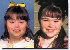 Down Syndrome Before And After Plastic Surgery 1
