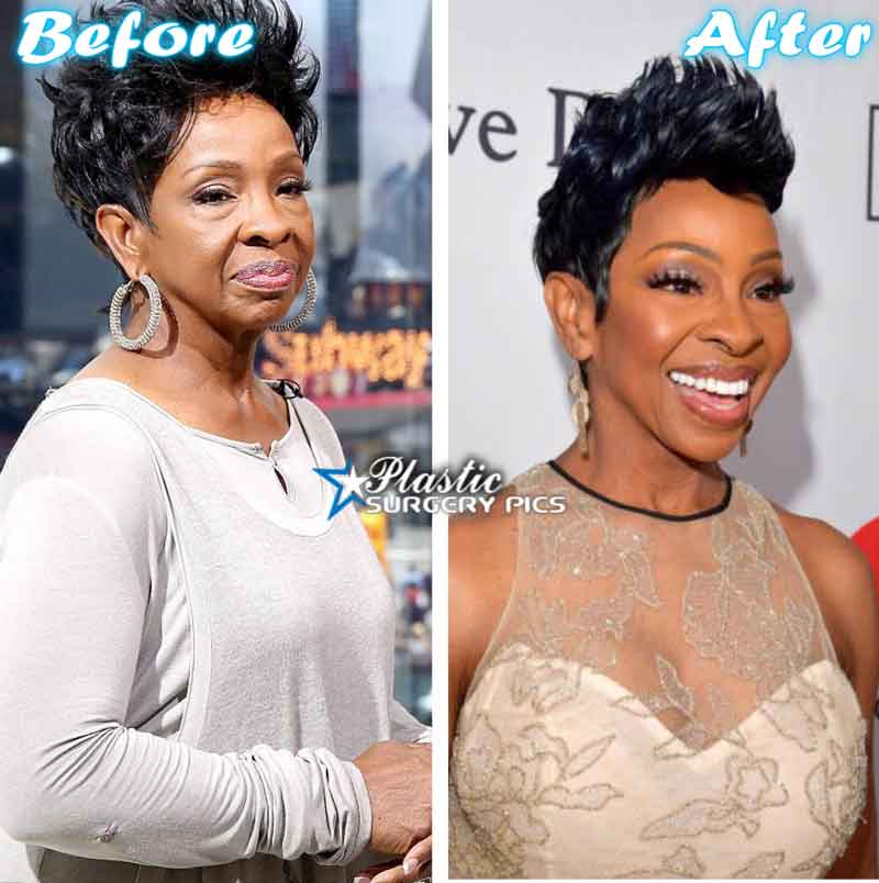 Gladys Knight Before And After Plastic Surgery 1
