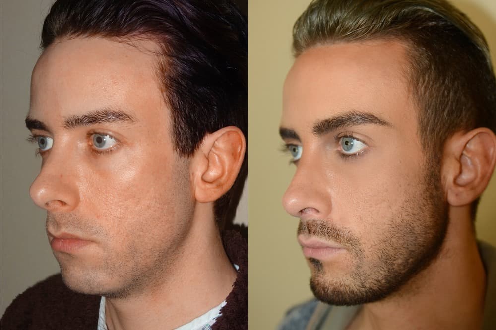 Guys Plastic Surgery Before And After 1