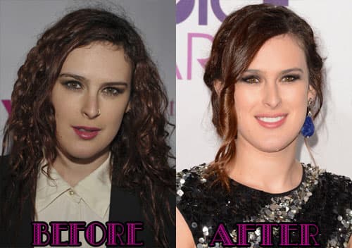 Hollywood Before And After Plastic Surgery 1