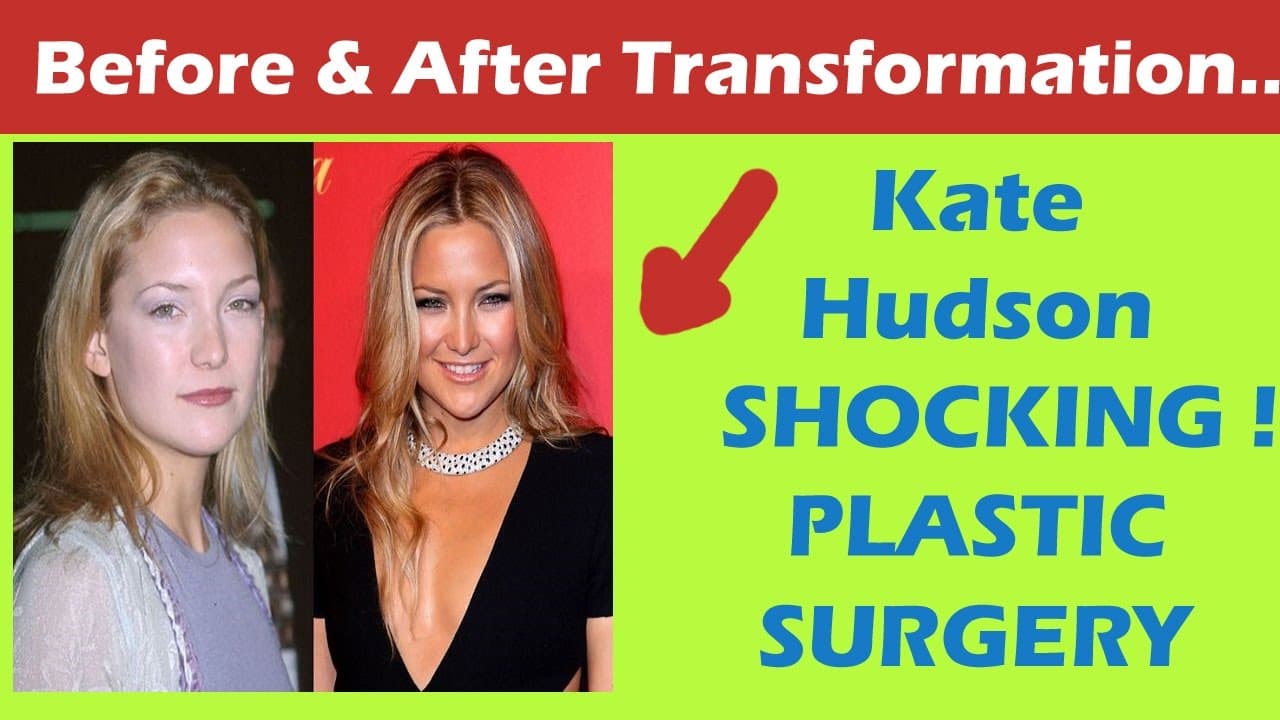 Kate Hudson Plastic Surgery Before And After Face 1