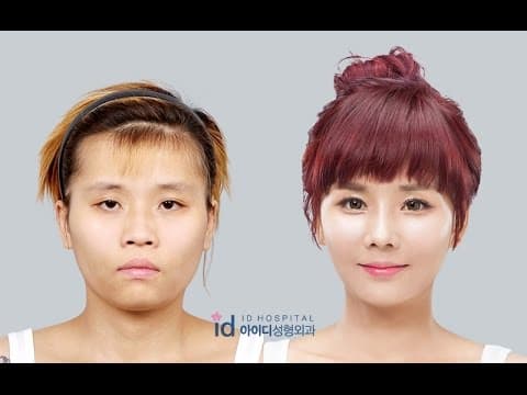 Korean Face Plastic Surgery Nose Before And After 1