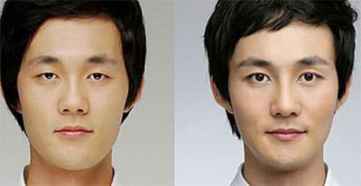 Korean Guy Plastic Surgery Before After 1