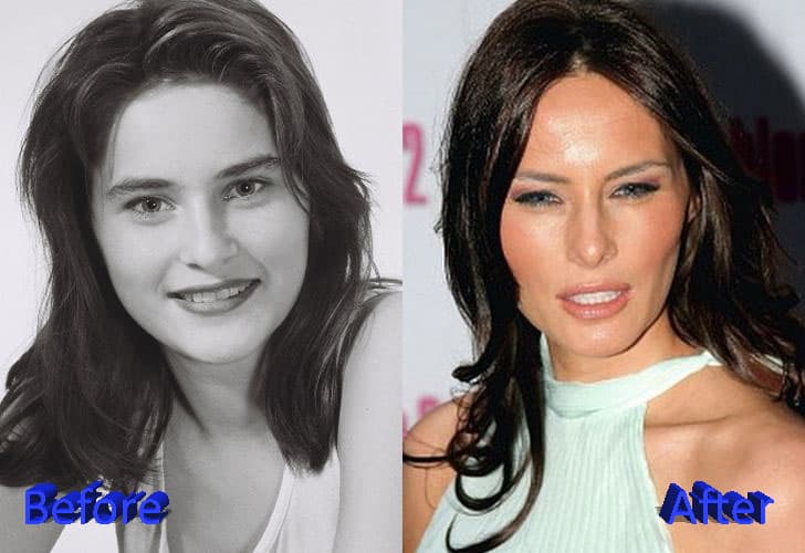 Melania Plastic Surgery Before After 1