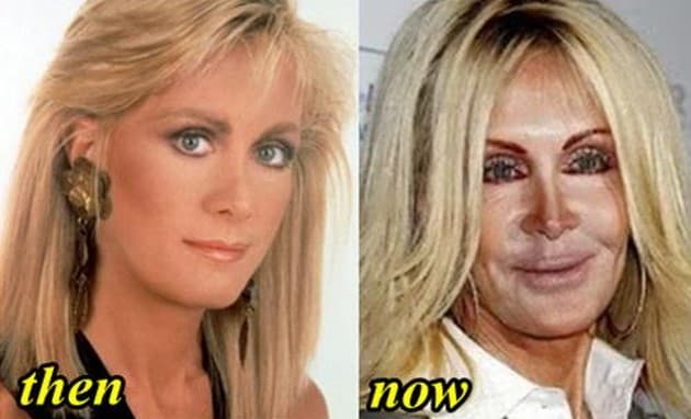 Nancy Pelosi Plastic Surgery Before And After Photos