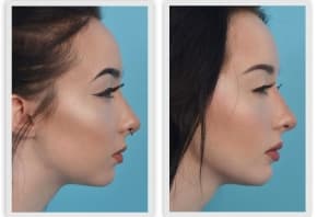 Plastic Surgery On The Neck Before And After 1