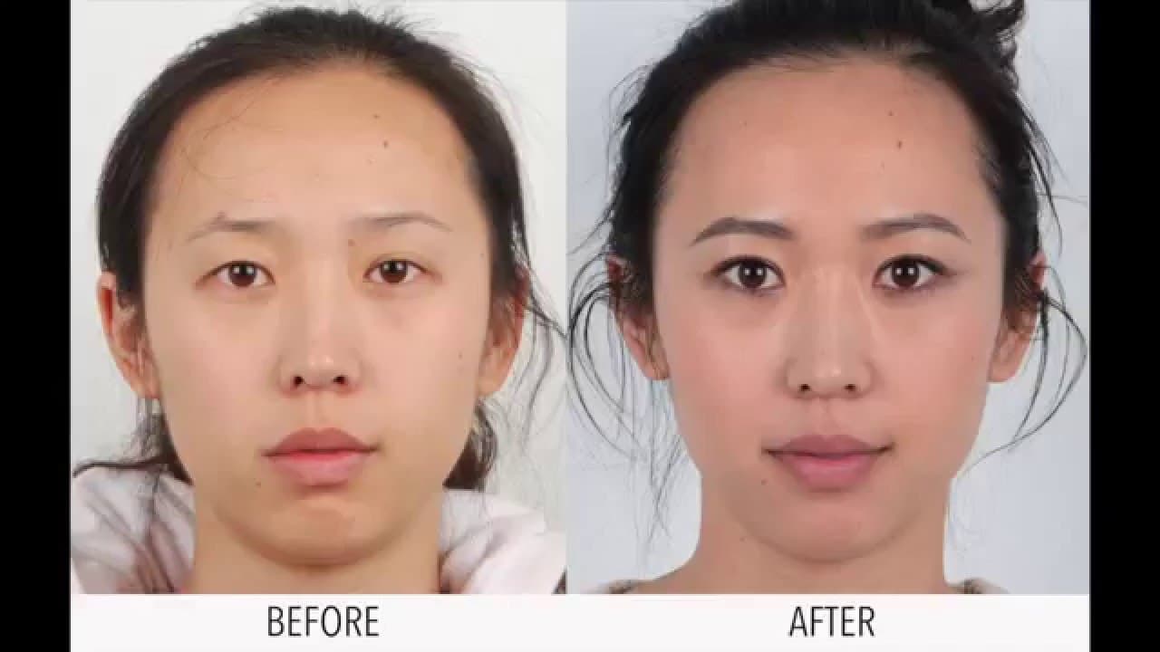 Women Plastic Surgery Before After 1