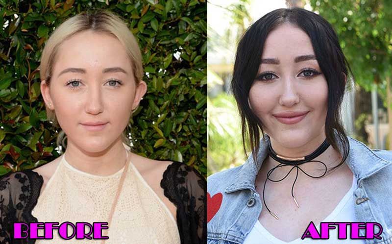 Noah Cyrus Plastic Surgery Before After