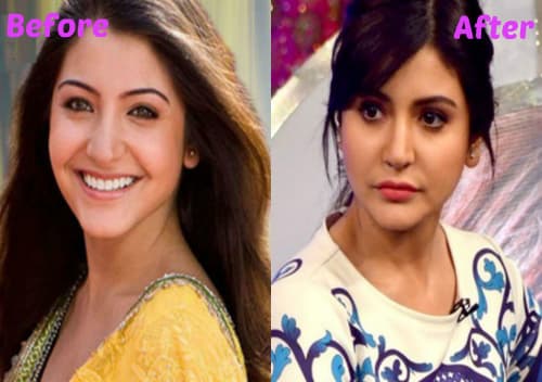Anushka Sharma Plastic Surgery Before And After 1