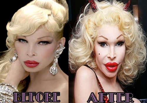Before After Plastic Surgery Face Celeb 1