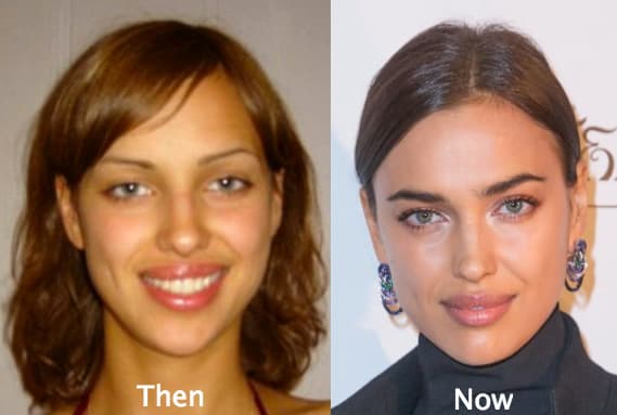 Before And After Korean Celebrity Plastic Surgery 1