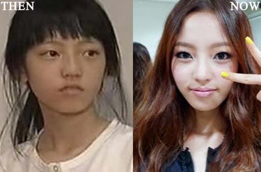 Before And After Korean Celebrity Plastic Surgery Sunny 1