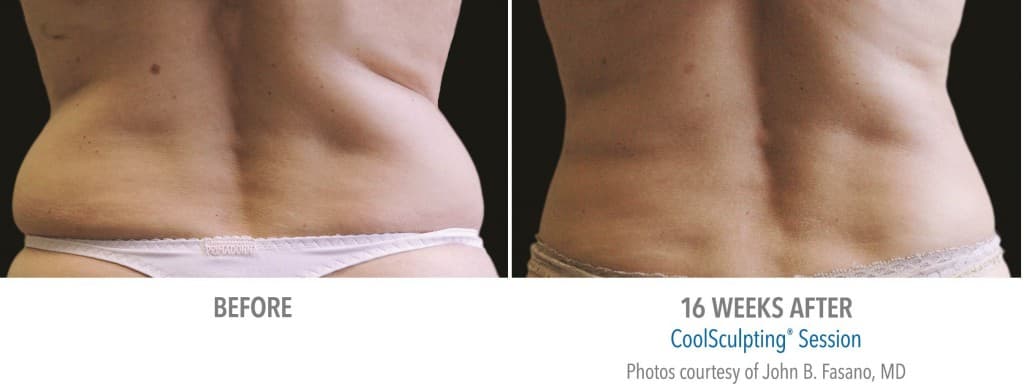 Before And After Of Plastic Surgery To Remove Love Handles 1