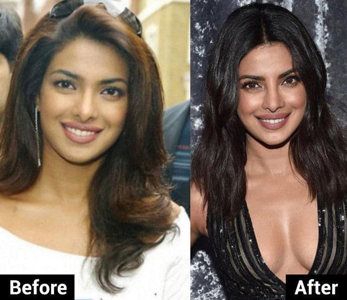 Before And After Pics Of Celebs Plastic Surgery 1