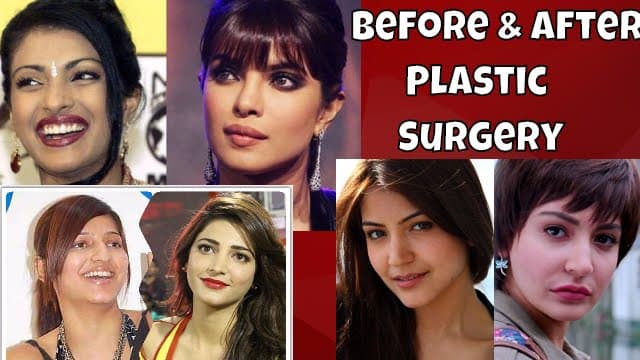 Bollywood Before And After Plastic Surgery 1