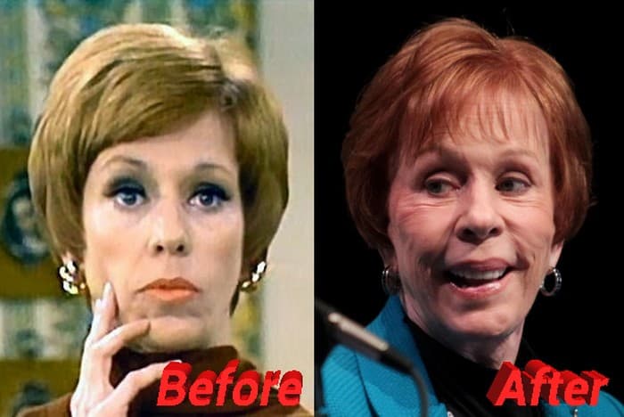 Carol Burnett Plastic Surgery Before And After 1