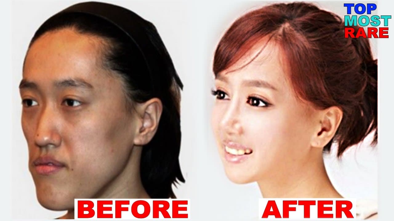 Chinese Actress Before And After Plastic Surgery 1