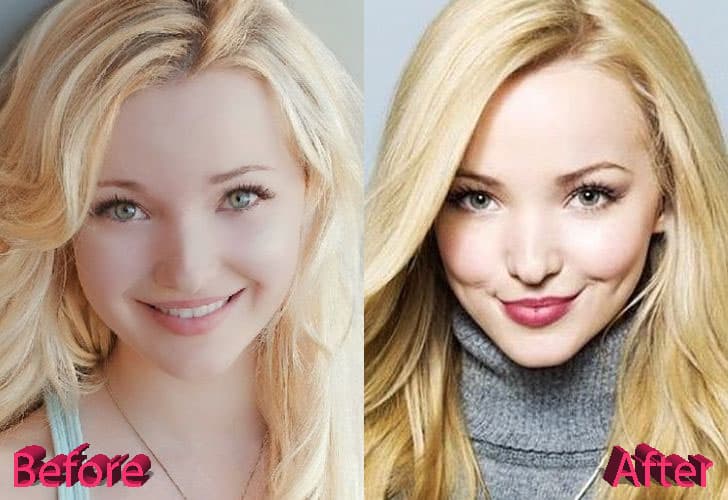 Dove Cameron Before Plastic Surgery After 1