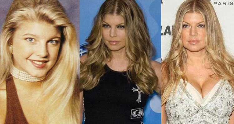 Fergie Plastic Surgery Before And After 1