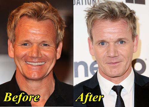 Gordan Ramsay After Plastic Surgery And Before 1